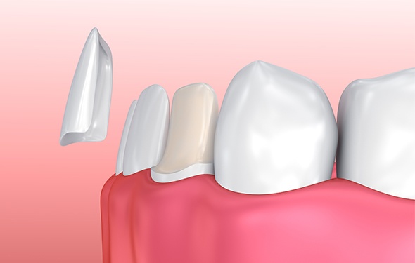 Animation of porcelain veneer placement