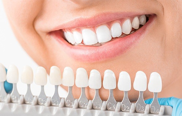 Woman's smile compared with tooth color chart