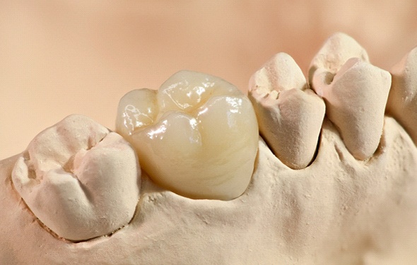 dental crown placed on a model of a mouth