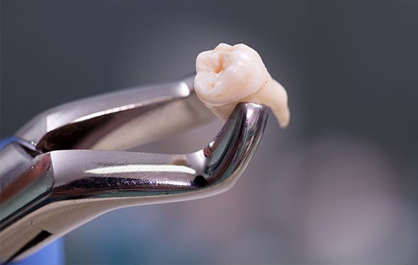 Metal clasp holding extracted tooth