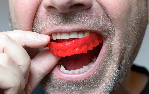 Man placing sports mouthguard