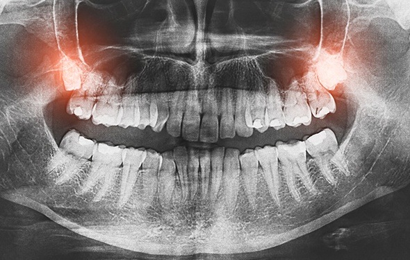 X-ray of impacted wisdom teeth