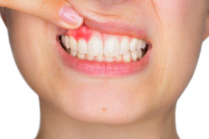 Woman with gum disease